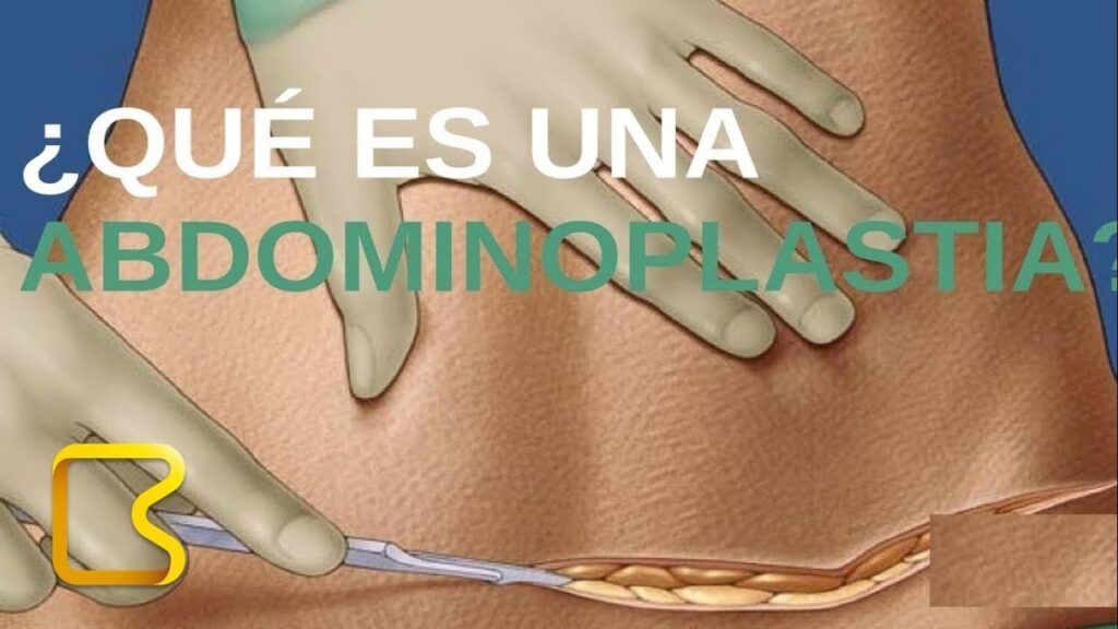Abdominoplastia: Guía Completa del Procedimiento