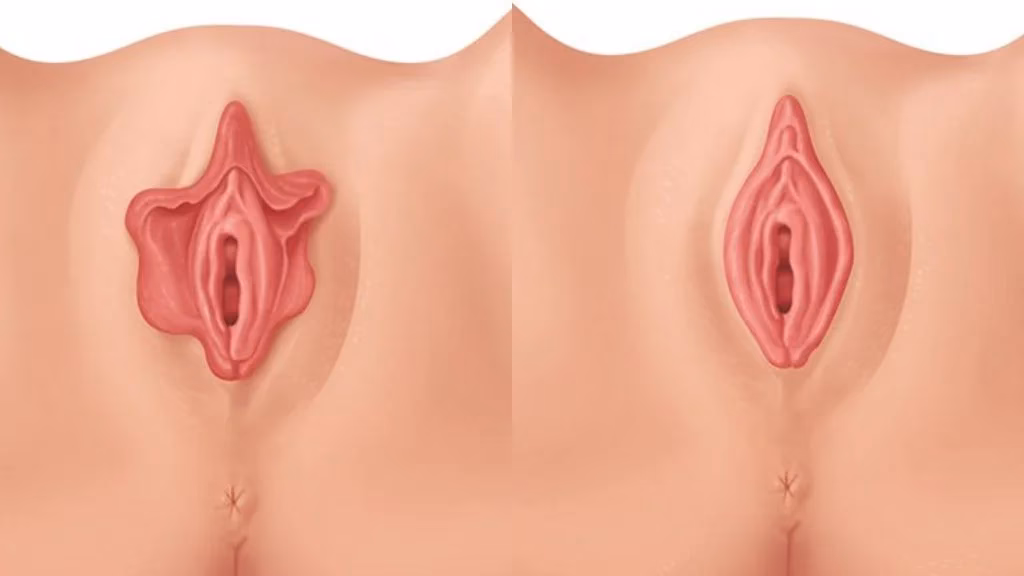 ¿Qué es el lifting vulvar?