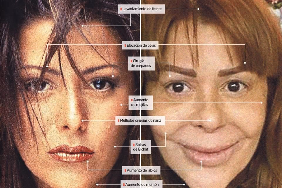 Alejandra Guzmán: El Peligro de los Biopolímeros