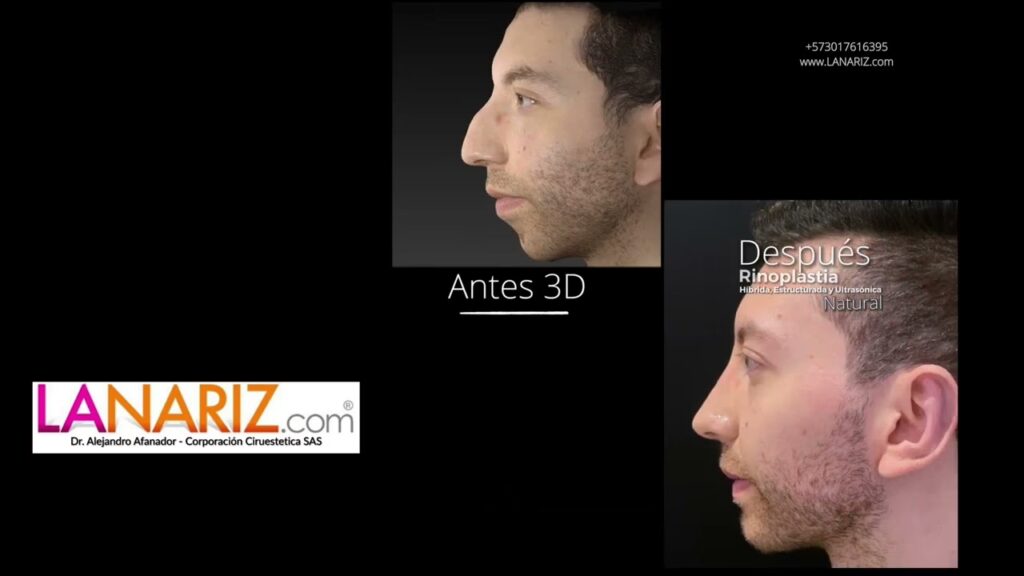 Rinoplastia: ¿Cirujano Plástico o Otorrino?