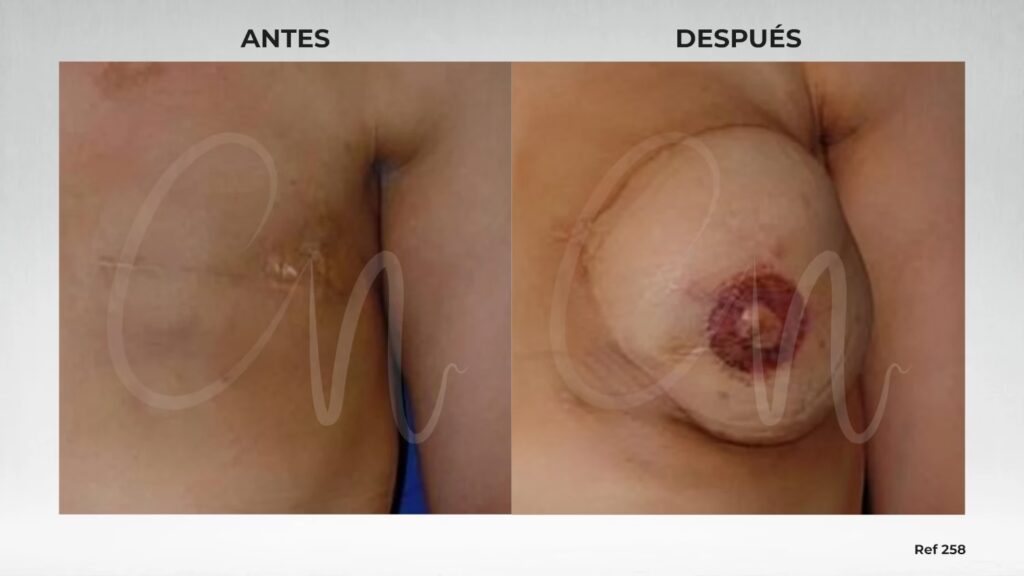 Lactancia y Cirugía de Pecho: ¿Son Compatibles?