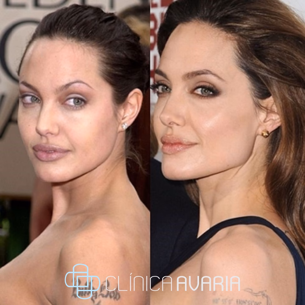 ¿Qué operación se realizó Angelina Jolie?