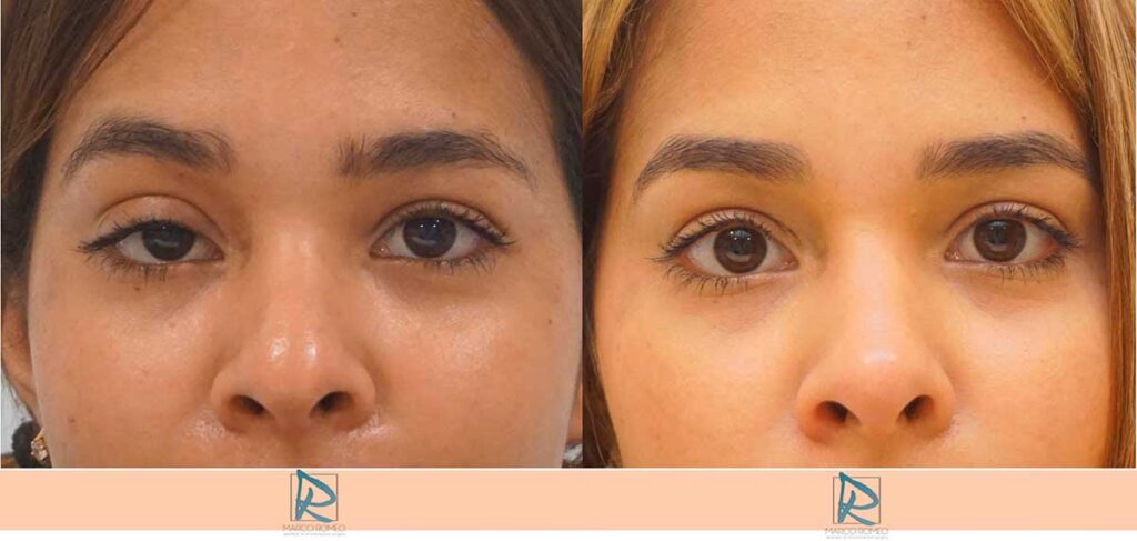 Blefaroplastia: ¿Cuántos años rejuvenece?