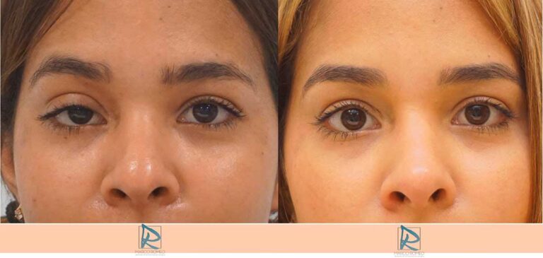 Blefaroplastia: ¿Cuántos años rejuvenece?