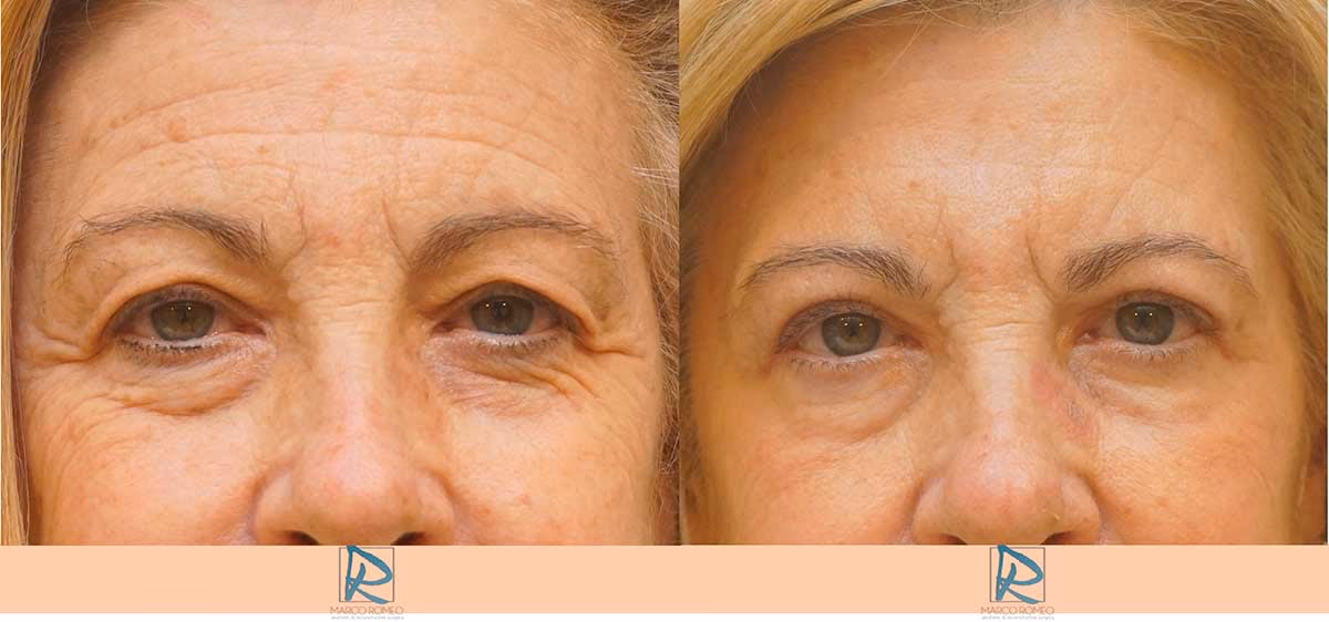 ¿Cuándo se verán normales mis ojos después de la blefaroplastia?