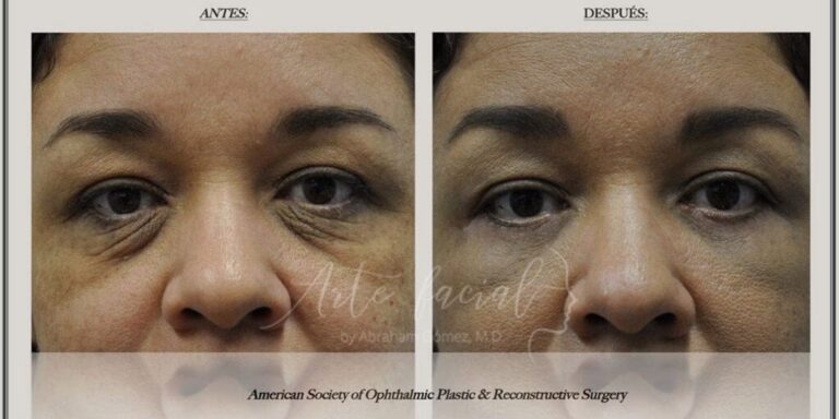 Blefaroplastia: ¿Láser o Cirugía Tradicional?