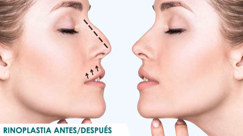 ¿Cómo queda una persona después de una operación de nariz?