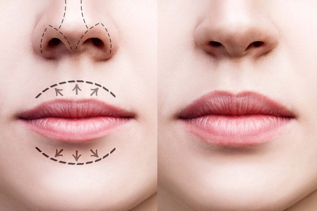 Lifting de Labios: Rejuvenece tu Sonrisa