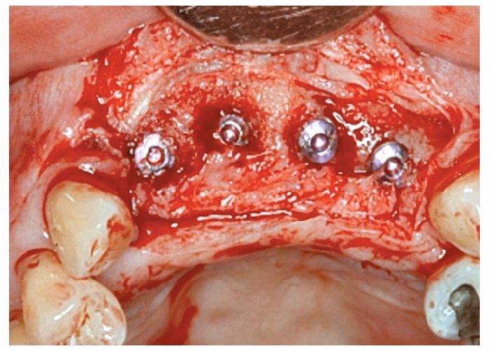 Reborde Residual: La Clave para Implantes y Prótesis