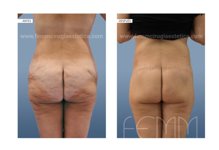 Body Lift: La Guía Definitiva de Remodelación