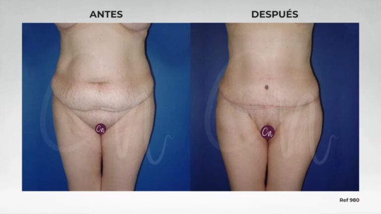 Costo de la Reducción de Cintura: Guía Completa