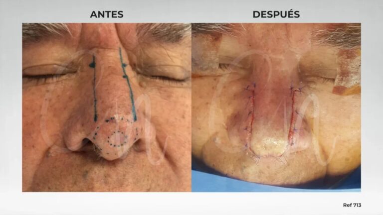 Cáncer de Piel: El Rol del Cirujano Plástico