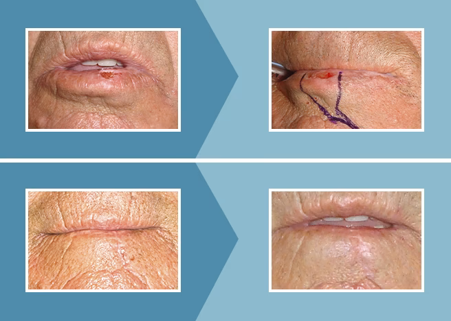 ¿Cómo es la cirugía para extirpar un carcinoma de piel?