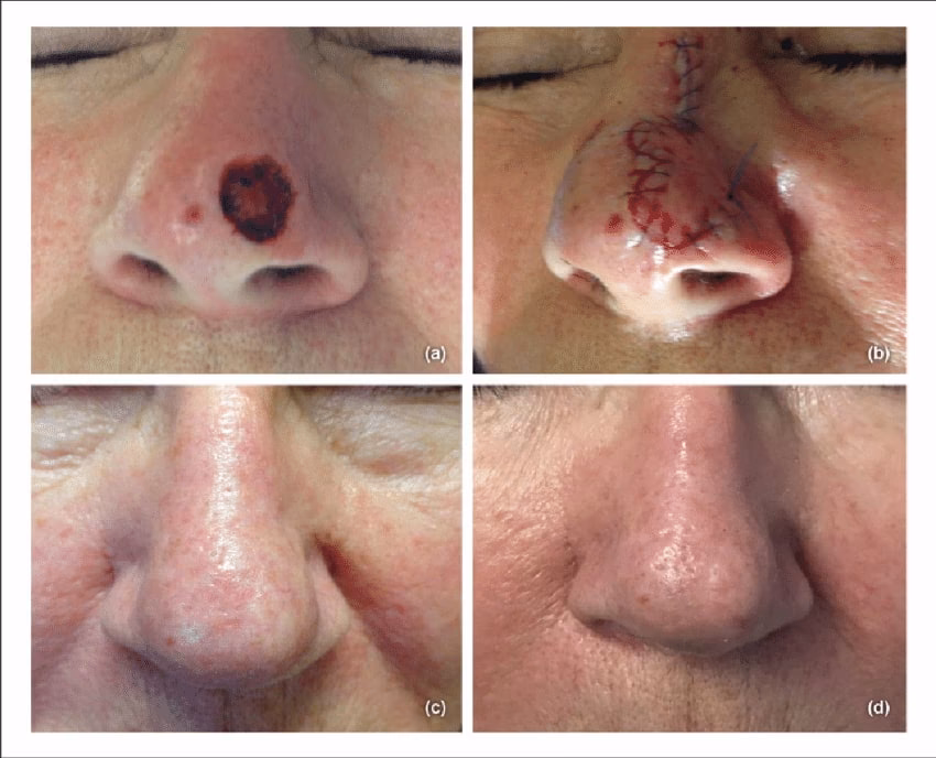 ¿Puede un cirujano plástico extirpar el cáncer de piel?