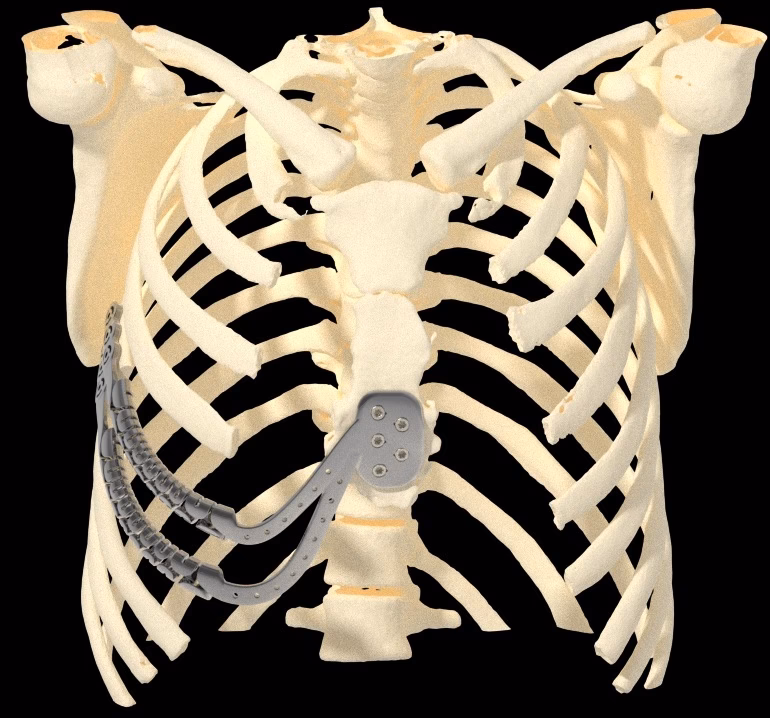 Rinoplastia: ¿Se Regenera el Cartílago de Costilla?