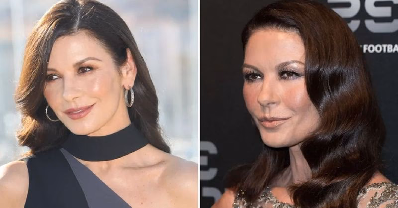¿Qué cirugía se hizo Catherine Zeta-Jones?