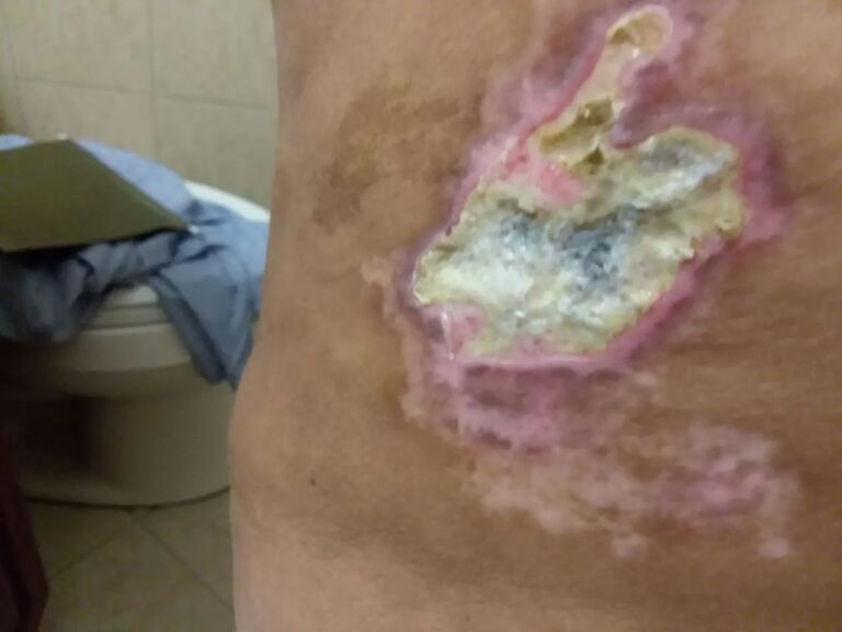 Mala Praxis en Cirugía Plástica: ¿Puedes Demandar?