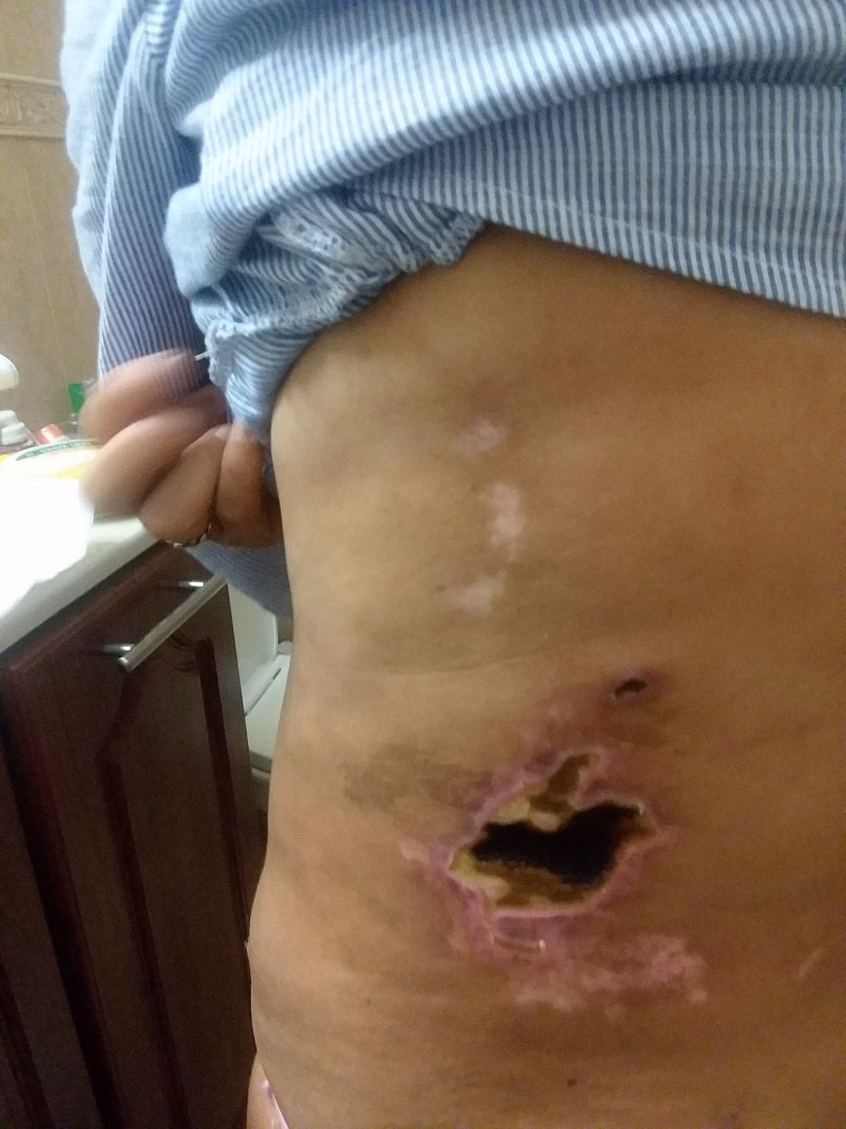 ¿Cuál es el riesgo de morir en una cirugía estética?