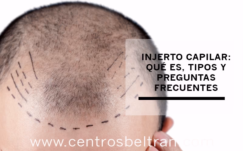 Trasplante Capilar: El Rol del Cirujano Plástico