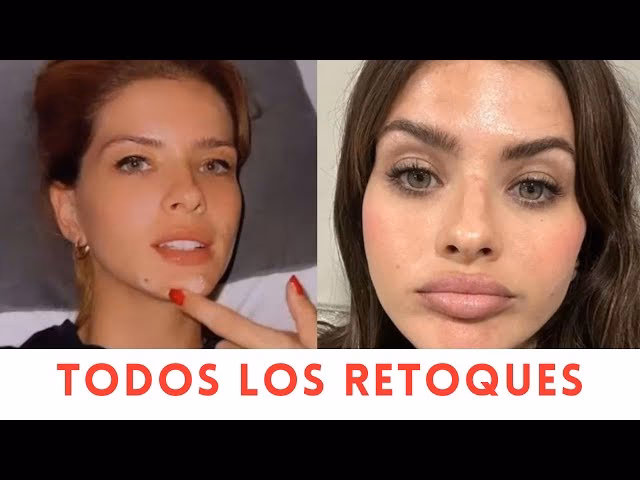 ¿Qué tiene hecho la China Suárez en la cara?