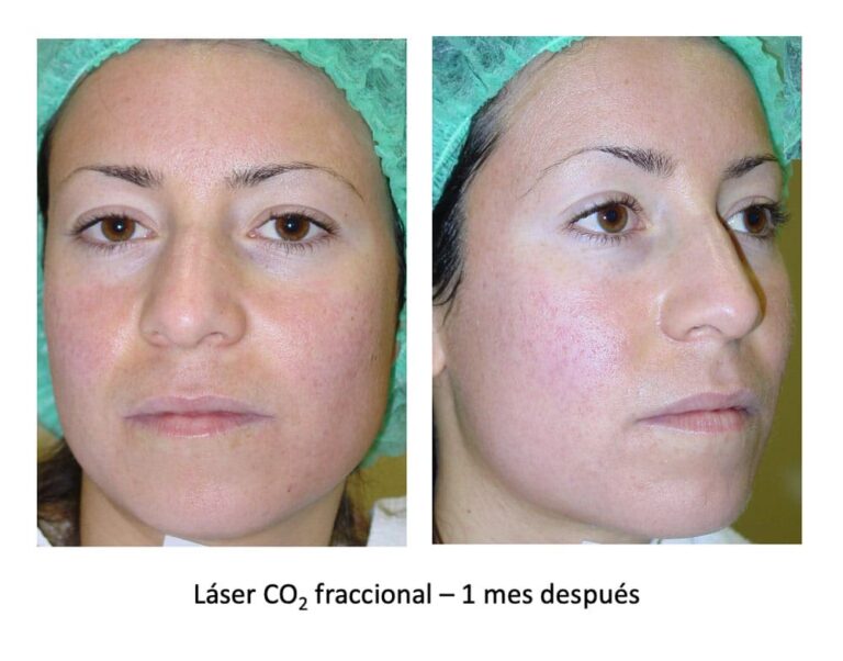 Coste del Láser para Cicatrices de Acné: Guía 2024