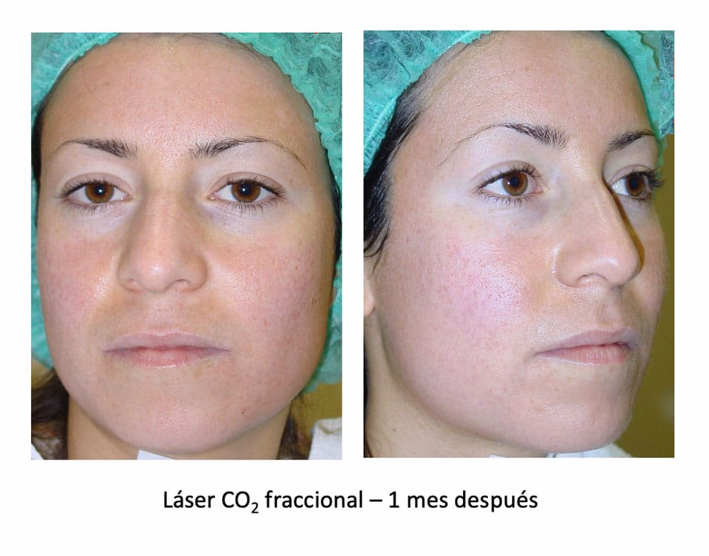 ¿Cuáles son las cicatrices de acné más dificiles de quitar?