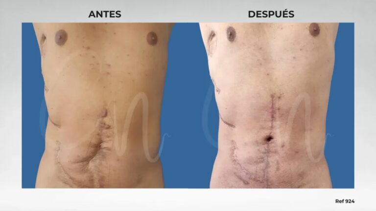 Costo de la Cirugía para Corregir Cicatrices