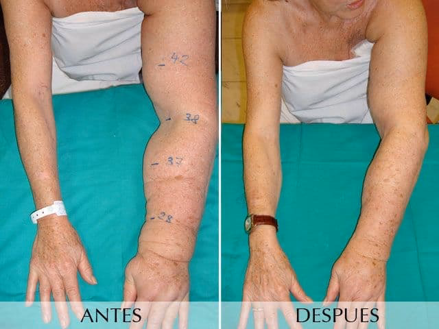 ¿Los cirujanos plásticos tratan el linfedema?