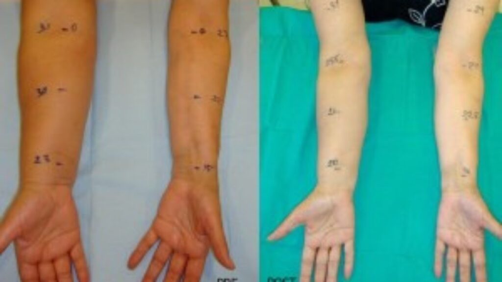 Cirugía Linfática: Guía Completa y Avanzada