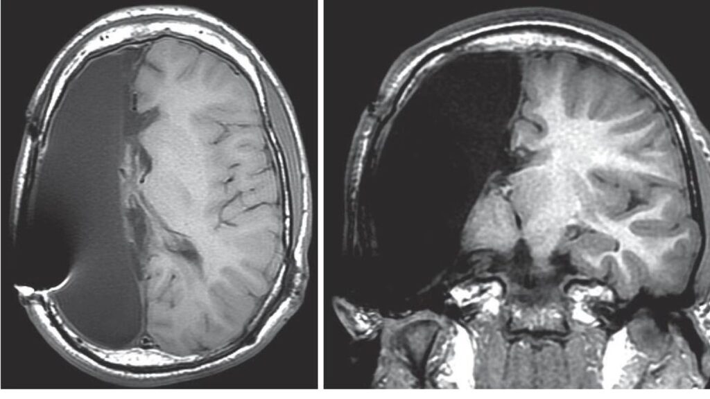Hemisferectomía: ¿Se Puede Vivir con Medio Cerebro?
