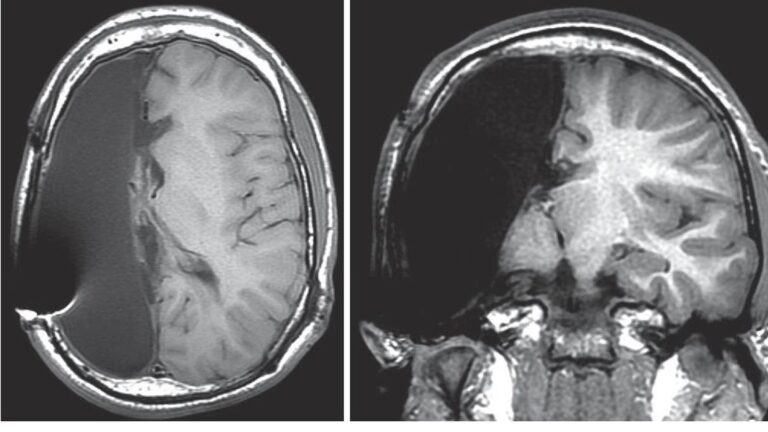 Hemisferectomía: ¿Se Puede Vivir con Medio Cerebro?