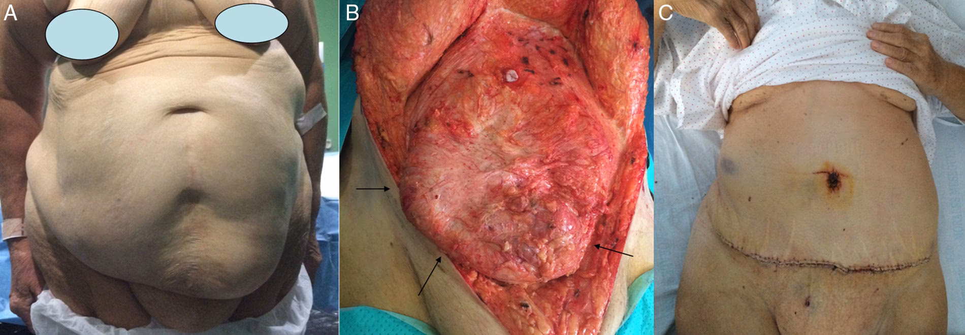 ¿Cuánto tiempo tarda en sanar una cirugía de eventración?