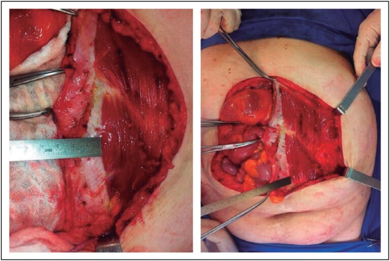 Eventración Gigante: Guía de Cirugía Reconstructiva