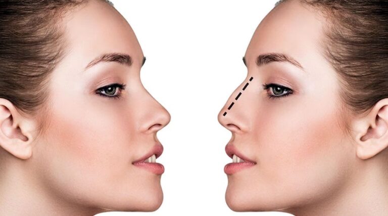 Rinoplastia: Belleza y Función Nasal