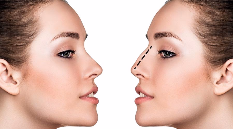 Rinoplastia: Belleza y Función Nasal