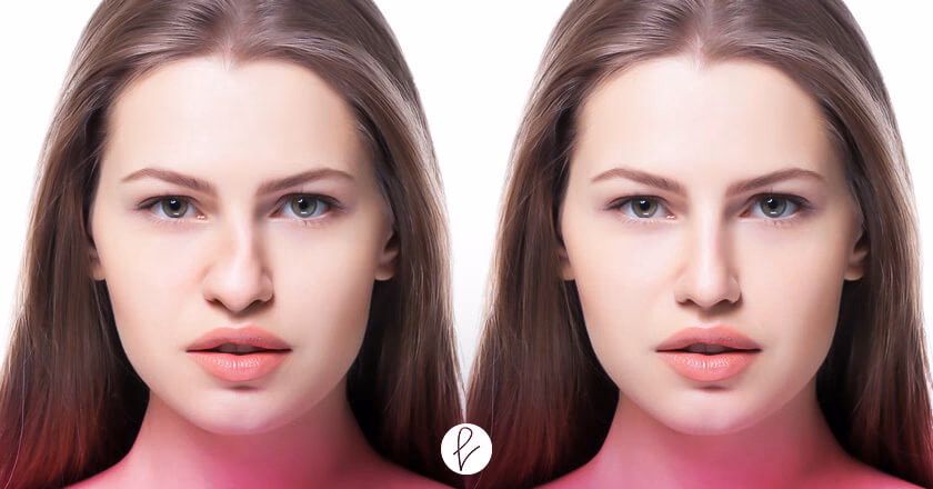¿Cuál es la diferencia entre la rinoplastia funcional y la estética?