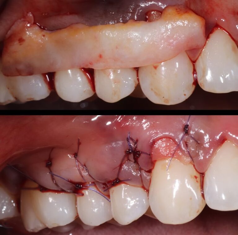 Cirugía Periodontal: Guía Completa de Precios 2024