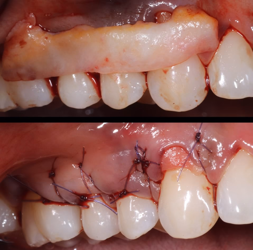 Cirugía Periodontal: Guía Completa de Precios 2024