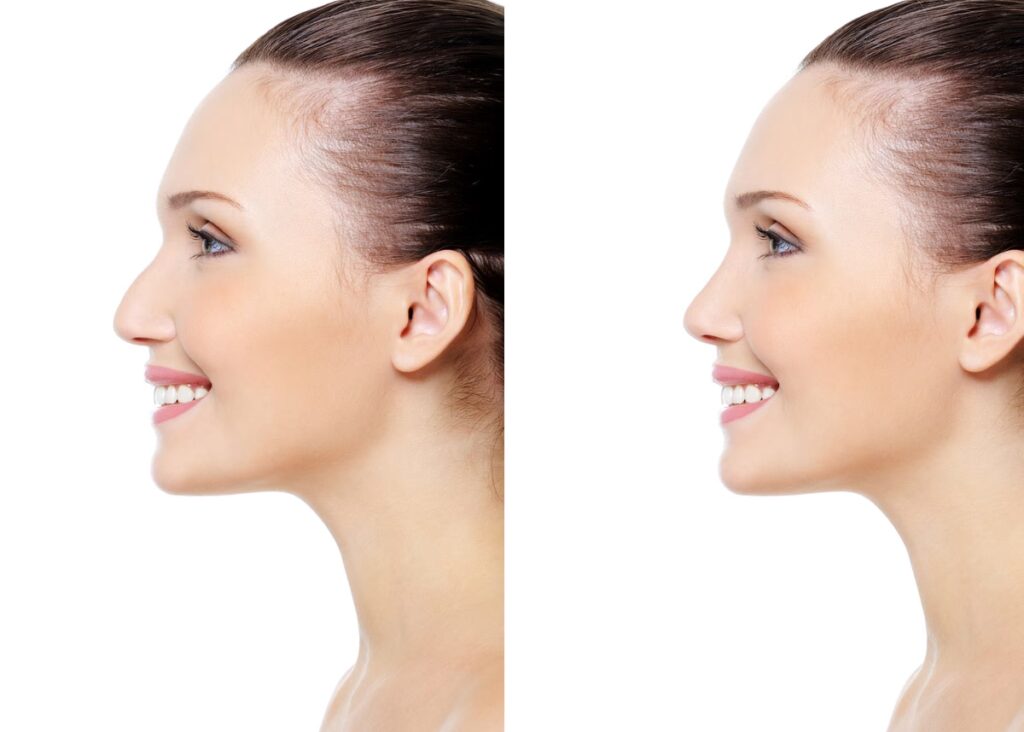 Cicatrices en Rinoplastia: Lo que Debes Saber