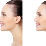 Nariz tras Cirugía de Sinusitis: La Guía Completa