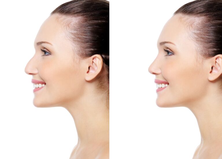 La Evolución de una Rinoplastia Mes a Mes