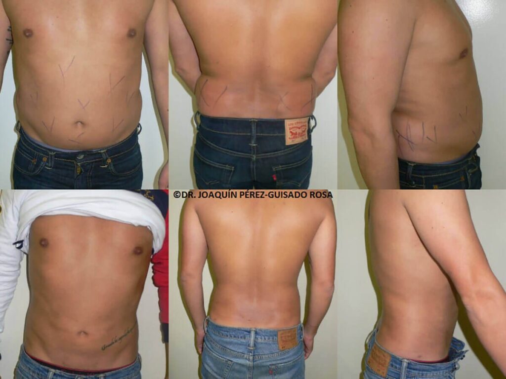 Abdominoplastia Masculina: Define tu Físico