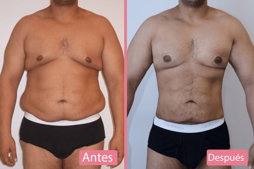 Cirugía de Diástasis Abdominal: La Solución Definitiva