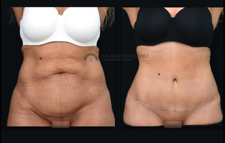 Remodelación Corporal: Cirugía para todo el cuerpo