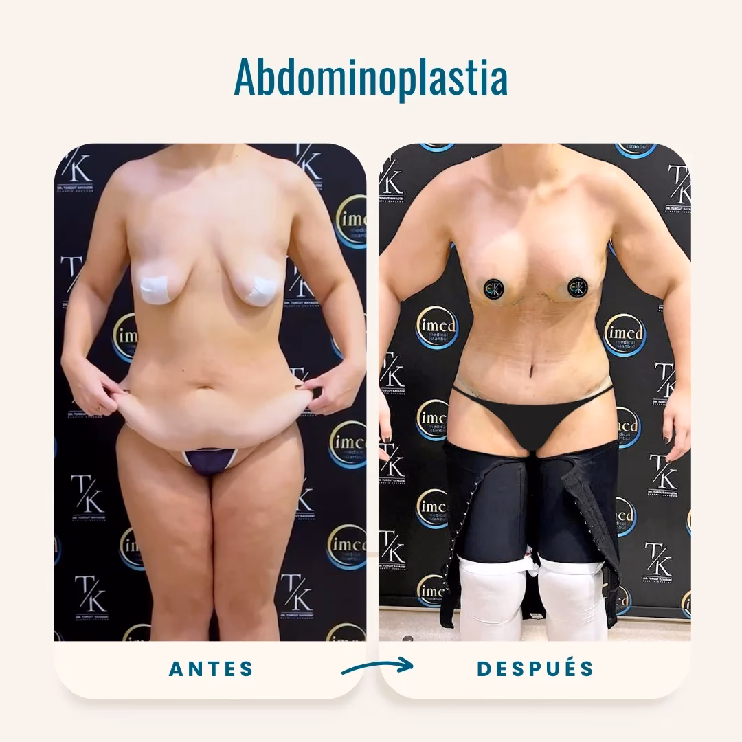 ¿Qué es una abdominoplastia con transferencia a glúteos?