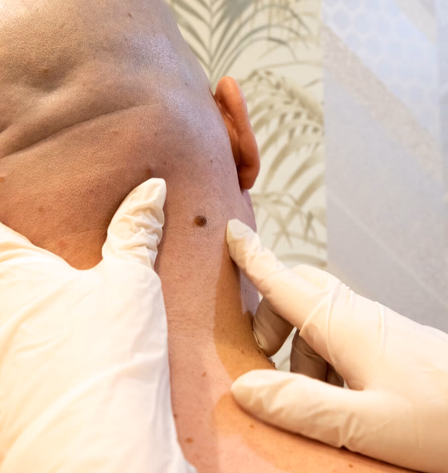 Eliminación de Lunares: Guía Definitiva y Segura