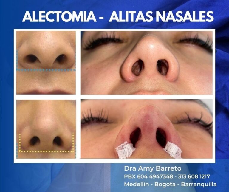 Alectomía: Corrige las Aletas de la Nariz