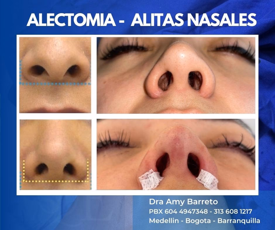 Alectomía: Corrige las Aletas de la Nariz