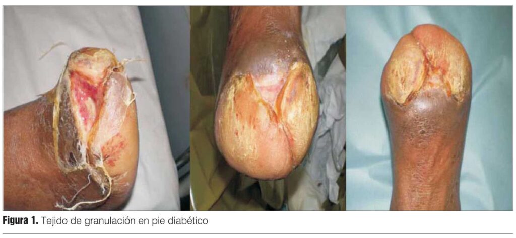 Cirugía para el Síndrome de Bandas Amnióticas