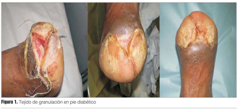 Cirugía para el Síndrome de Bandas Amnióticas